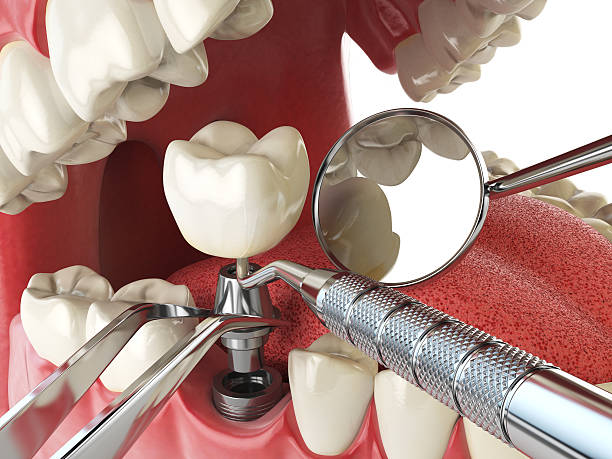 Best Emergency Root Canal Treatment in Kingsville, MD